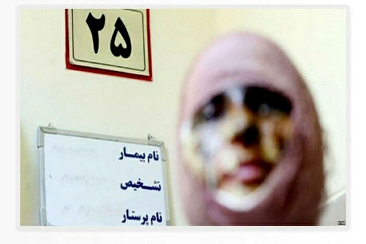 اسیدپاشی مرد شکاک به همسرش و همکار او در تهران