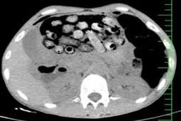 خروج ۹۰ بسته مواد مخدر از معده و روده یک بیمار در کرج
