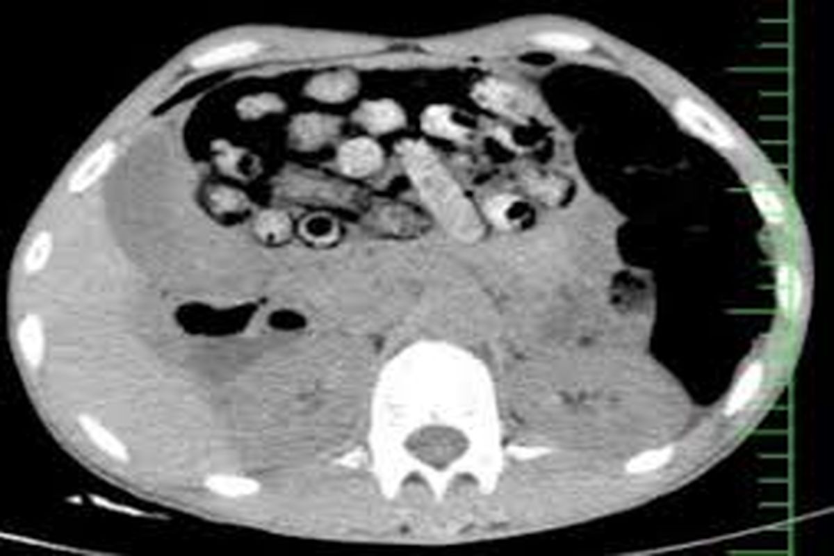 خروج ۹۰ بسته مواد مخدر از معده و روده یک بیمار در کرج