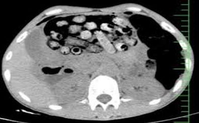 خروج ۹۰ بسته مواد مخدر از معده و روده یک بیمار در کرج