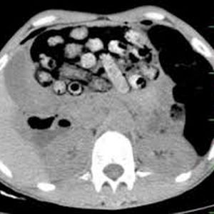 خروج ۹۰ بسته مواد مخدر از معده و روده یک بیمار در کرج
