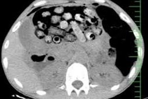 خروج ۹۰ بسته مواد مخدر از معده و روده یک بیمار در کرج
