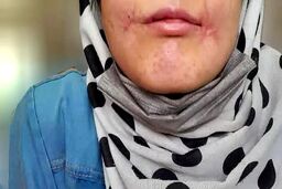 مرد مشهدی لب‌های زن ۱۸ ساله‌اش را دوخت/ فائزه به کلانتری پناه برد