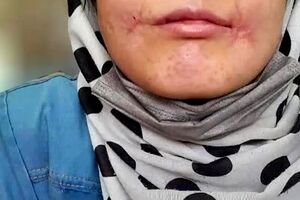مرد مشهدی لب‌های زن ۱۸ ساله‌اش را دوخت/ فائزه به کلانتری پناه برد