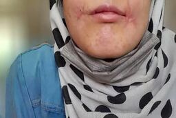 مرد مشهدی لب‌های زن ۱۸ ساله‌اش را دوخت/ فائزه به کلانتری پناه برد