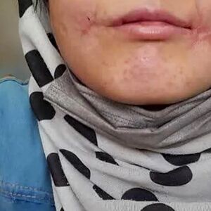 مرد مشهدی لب‌های زن ۱۸ ساله‌اش را دوخت/ فائزه به کلانتری پناه برد