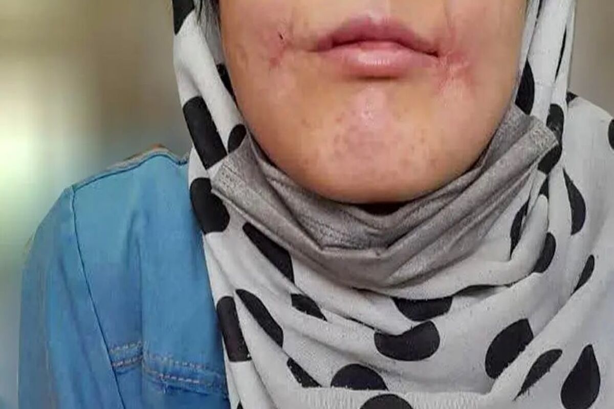 مرد مشهدی لب‌های زن ۱۸ ساله‌اش را دوخت/ فائزه به کلانتری پناه برد