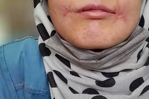 مرد مشهدی لب‌های زن ۱۸ ساله‌اش را دوخت/ فائزه به کلانتری پناه برد