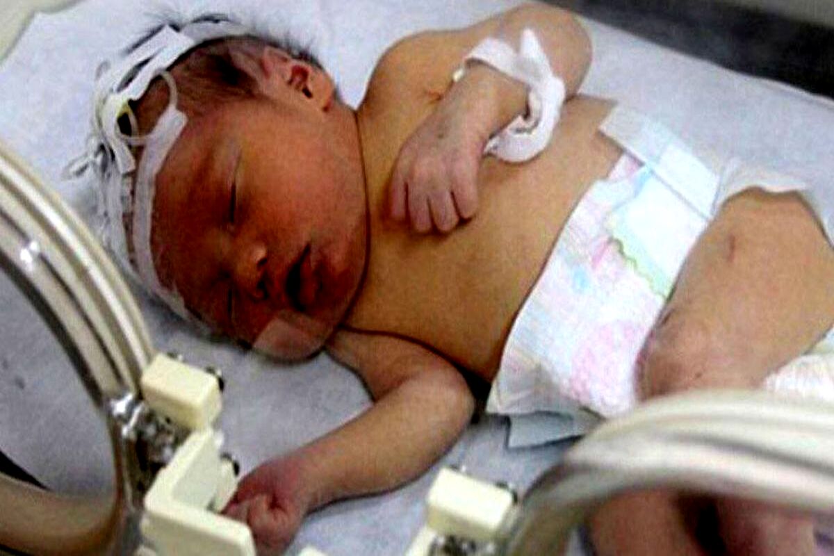 قطع نخاع نوزاد ۵ ماهه گلستانی بر اثر شکستن قلنج